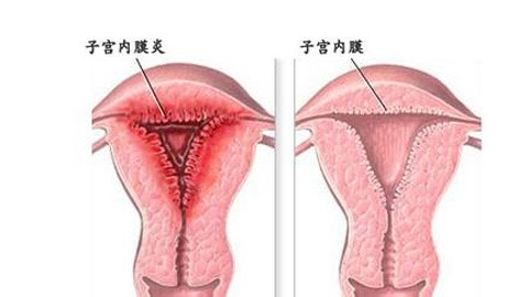 子宫内膜厚怎么治疗调理 子宫内膜厚怎么治疗调理17mm